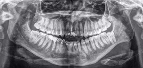 Why Does Your Dentist Need Dental X-Rays? | Cawthra Dental